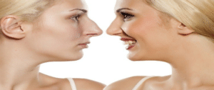 ما مدة عملية تجميل الانف؟ ولماذا نلجأ إليها من الأساس؟ 2 تجميل الانف