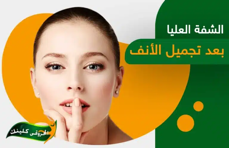 متي يختفي تورم الشفة العليا بعد تجميل الأنف؟ 12 الشفة العليا بعد تجميل الأنف