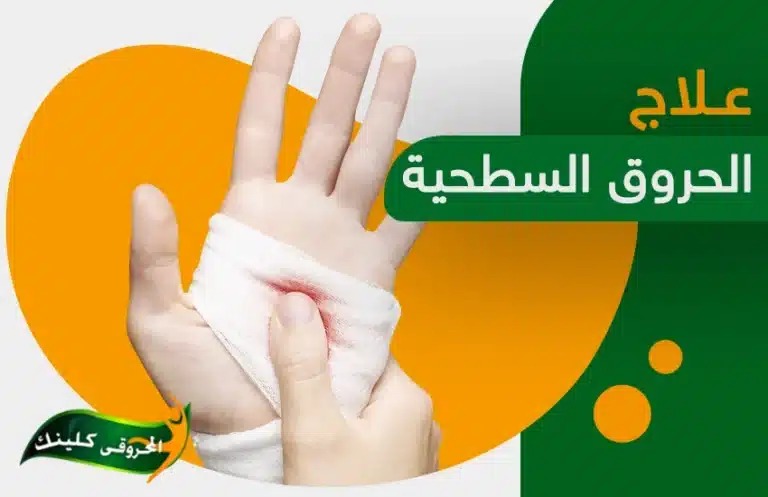 علاج الحروق السطحية والتخلص من آثارها في دقائق معدودة 10 علاج الحروق السطحية