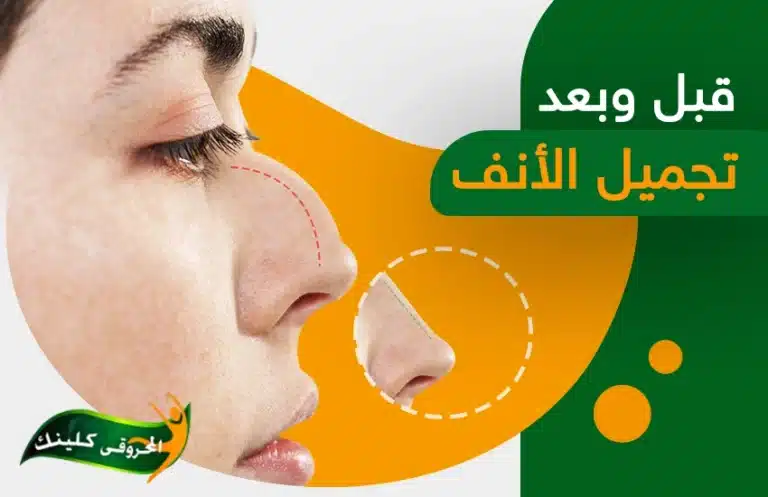 فروقات واضحة في نتائج عمليات تجميل الأنف قبل وبعد بالصور 6 عمليات تجميل الأنف قبل وبعد بالصور