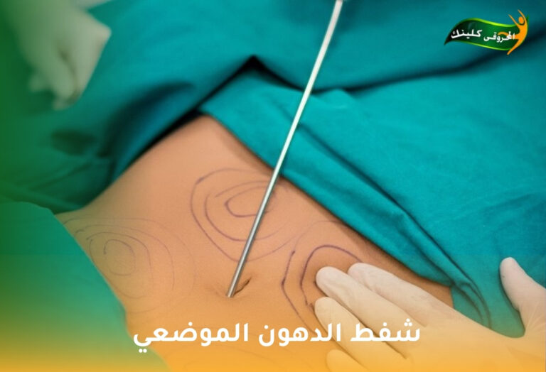 شفط الدهون الموضعي 4 شفط الدهون الموضعي