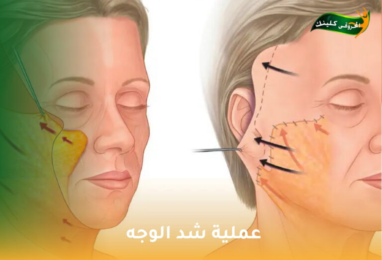 الدليل الكامل لعملية شد الوجه: استعادة الشباب والحيوية بلمسة فنية 10 عملية شد الوجه
