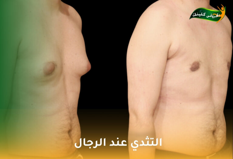 الدليل الشامل لعلاج التثدي عند الرجال: استعادة المظهر الذكوري والثقة 9 التثدي عند الرجال