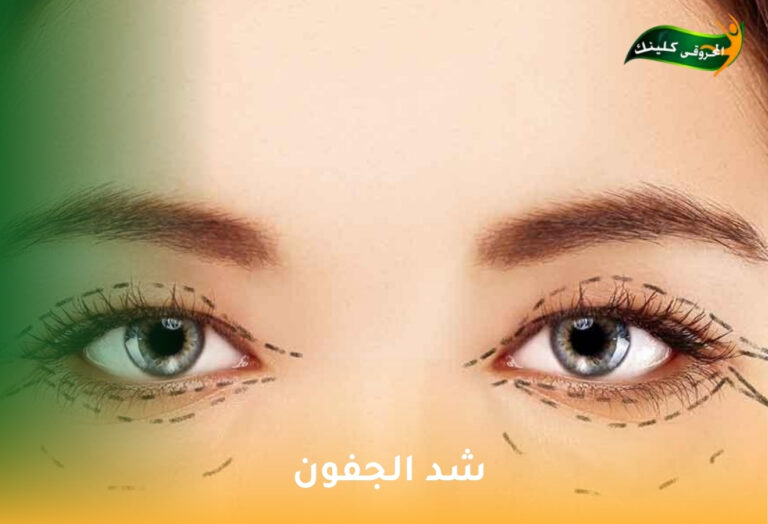 شد الجفون: استعادة شباب العيون بلمسة فنية 3 شد الجفون
