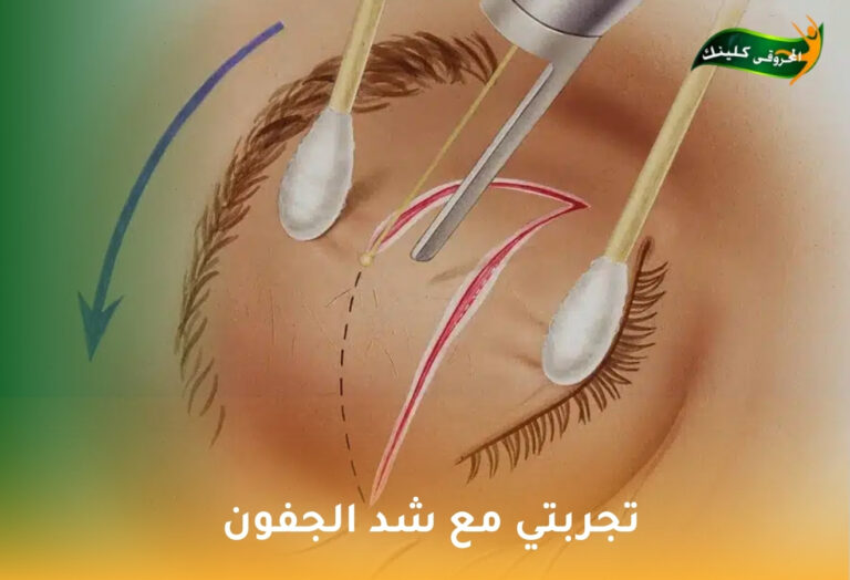 تجربتي مع شد الجفون: قصص واقعية نحو عيون أكثر شبابًا 7 تجربتي مع شد الجفون