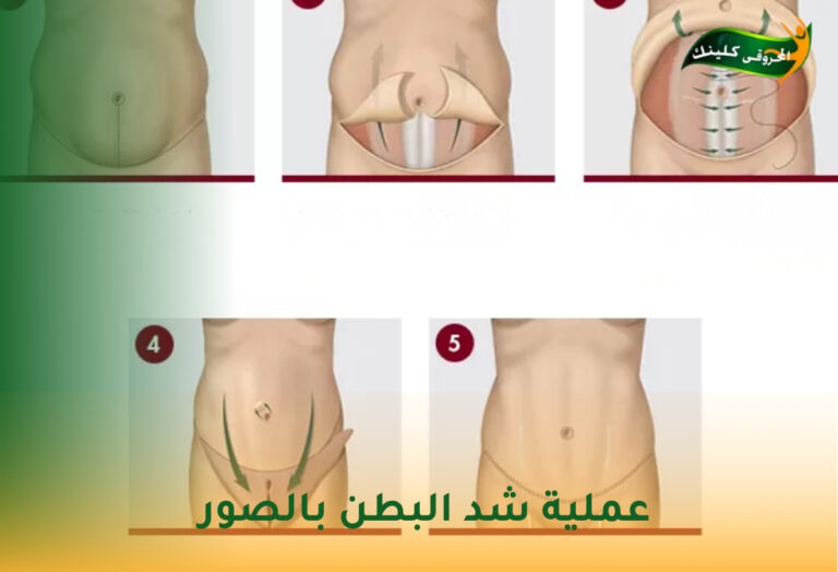 عملية شد البطن بالصور: دليلك الشامل لاستعادة قوام رشيق ومشدود 8 عملية شد البطن بالصور