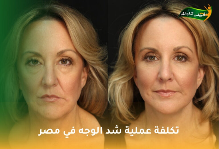 تكلفة عملية شد الوجه في مصر 3 تكلفة عملية شد الوجه في مصر