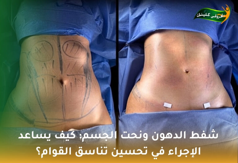 شفط الدهون ونحت الجسم: كيف يساعد الإجراء في تحسين تناسق القوام؟ 2 شفط الدهون ونحت الجسم