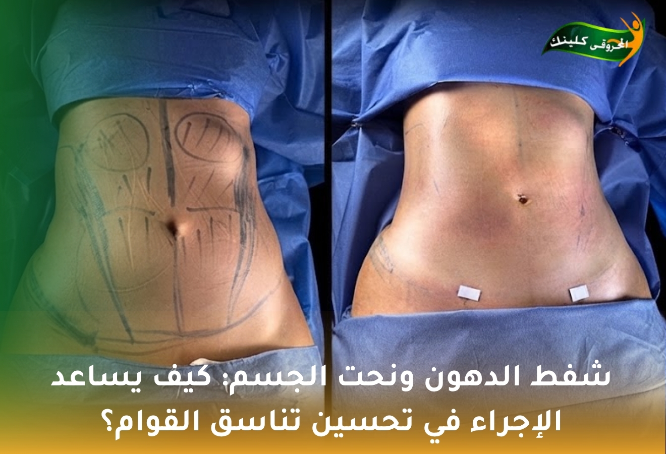 شفط الدهون ونحت الجسم: كيف يساعد الإجراء في تحسين تناسق القوام؟ 1 شفط الدهون ونحت الجسم
